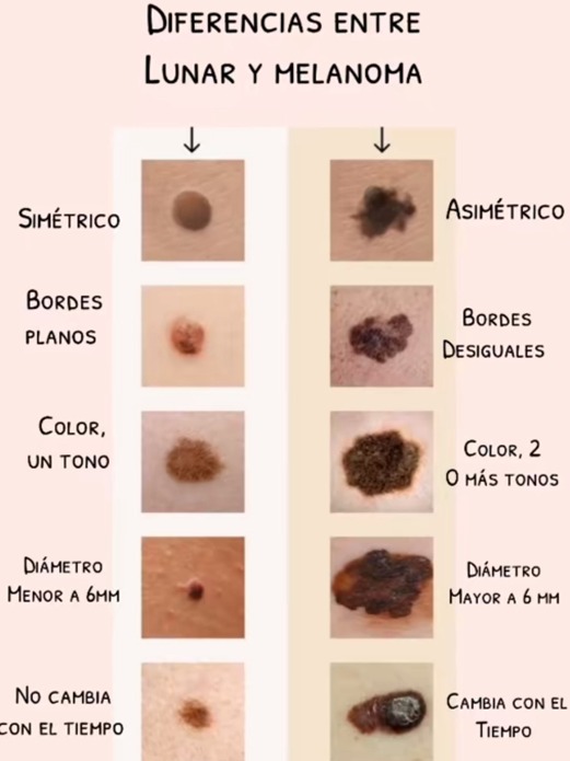 Infografía con las diferencias entre un lunar común y un melanoma: simetría, bordes, color, diámetro y evolución