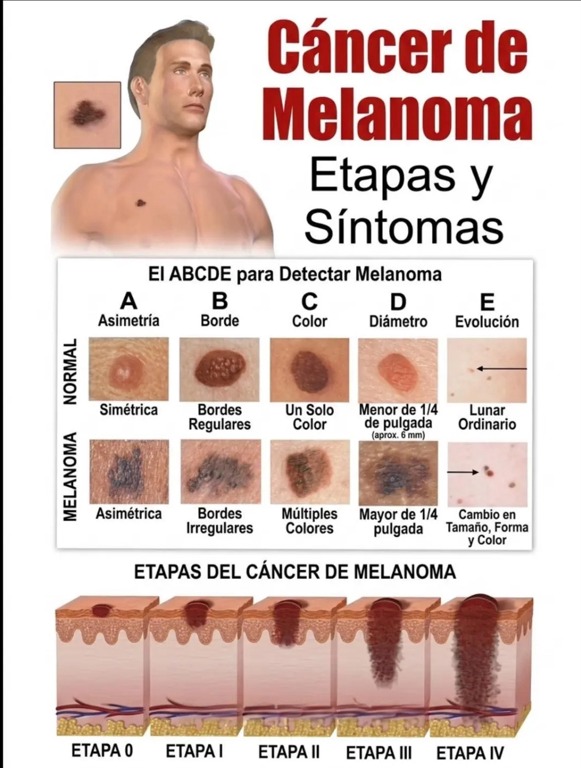 Infografía sobre la regla ABCDE y las etapas del cáncer de melanoma