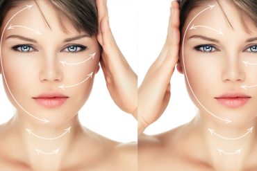 Lifting Facial sin bisturí